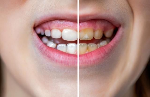 traitement caries