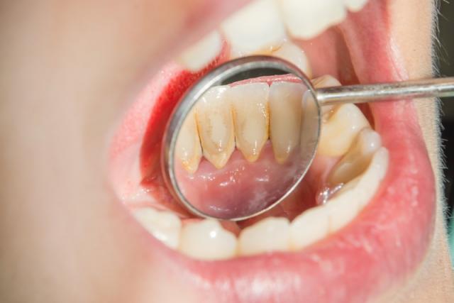 détartrage dentiste