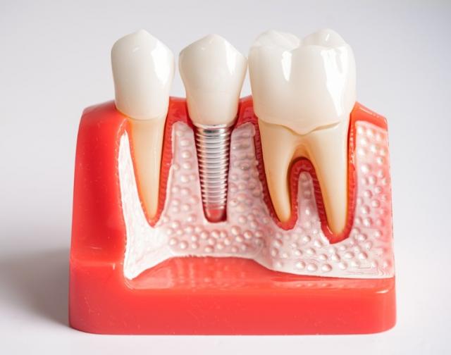 implant dentaire